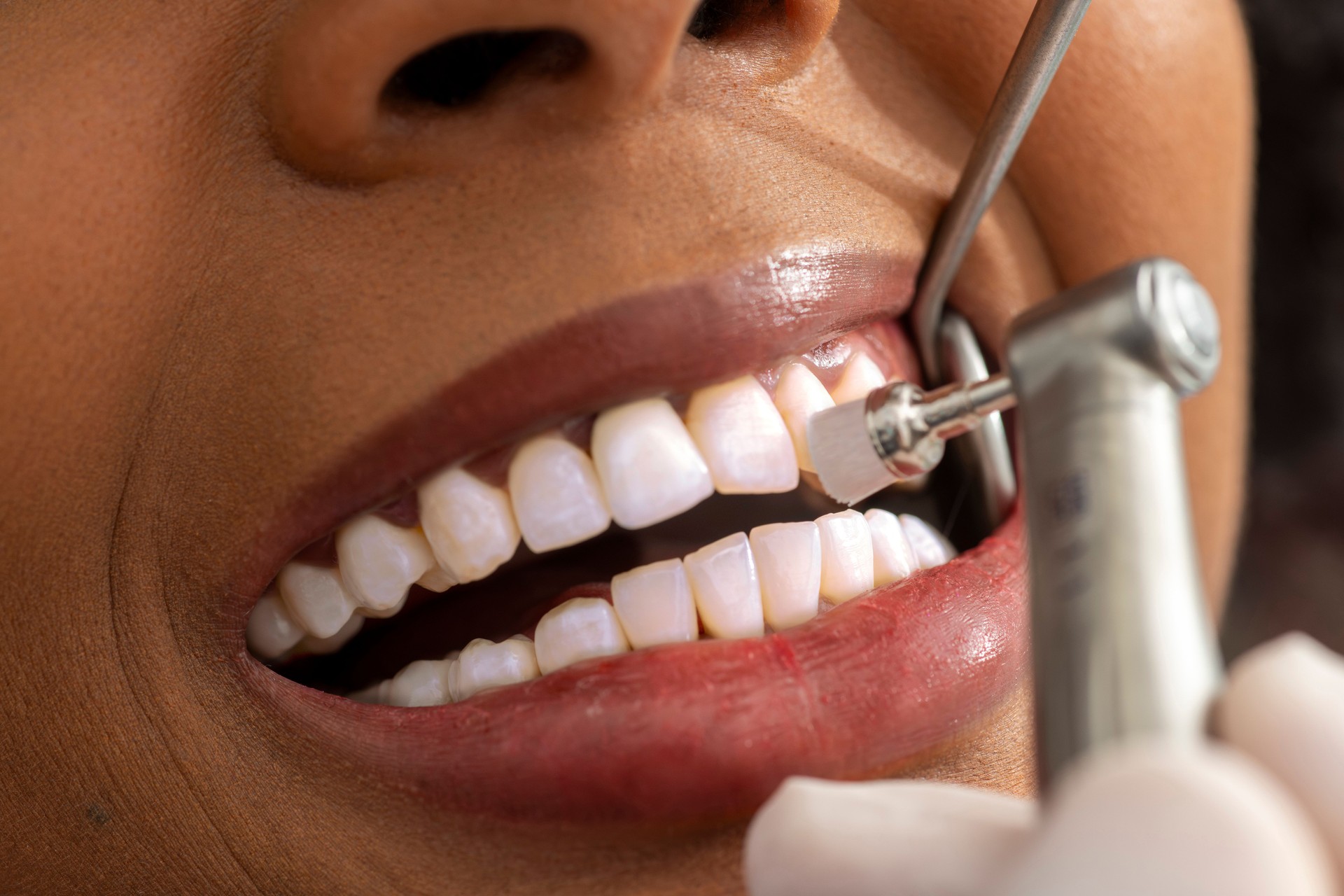 Dentist polishing teeth of patient in dental clinic